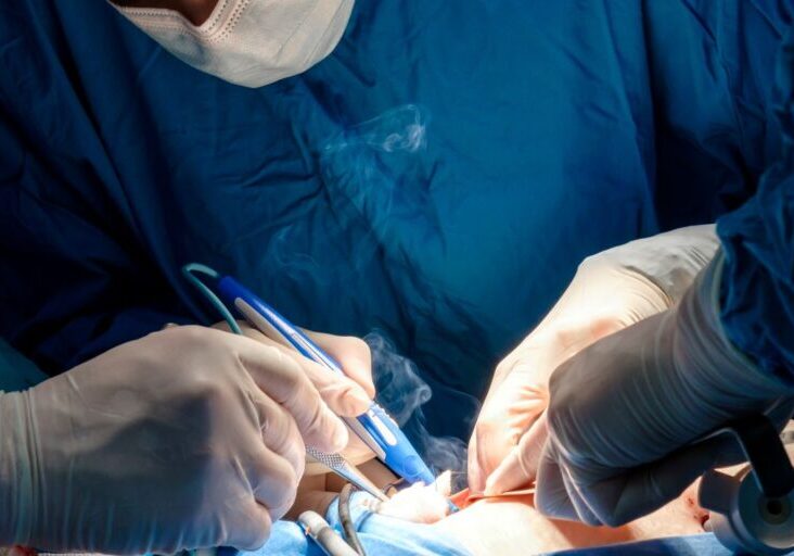 Surgeon using electric coagulator causing surgical smoke.